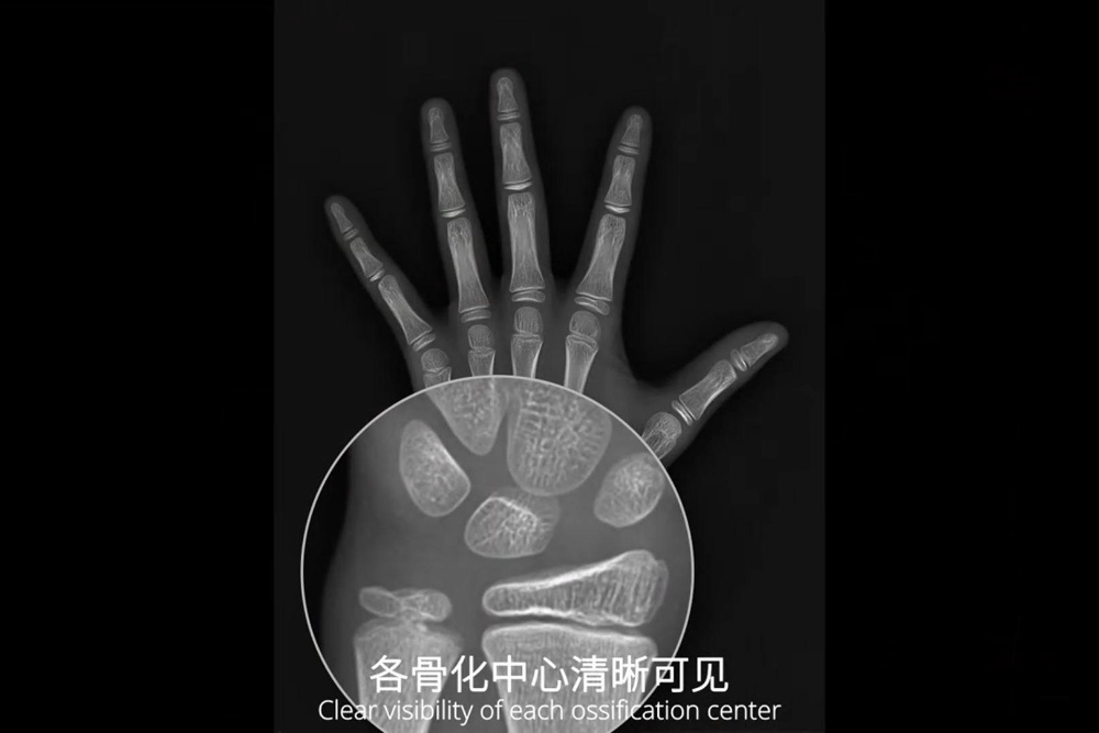 中华05和TW3哪种标准测评骨龄更准确?安智龄儿童骨龄AI评估软件,双标准赋能精准医疗 ! 中华05和TW3哪种标准测评骨龄更准确?安智龄儿童骨龄AI评估软件,双标准赋能精准医疗 !