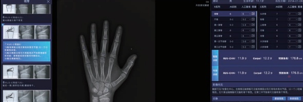 中华05和TW3哪种标准测评骨龄更准确？安智龄儿童骨龄AI评估软件，双标准赋能精准医疗 ！