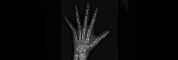 中华05标准骨龄检测：精准评估儿童发育，解码成长密码