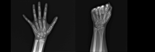 骨龄与骨密度有什么区别？解析两者的定义、检测与应用