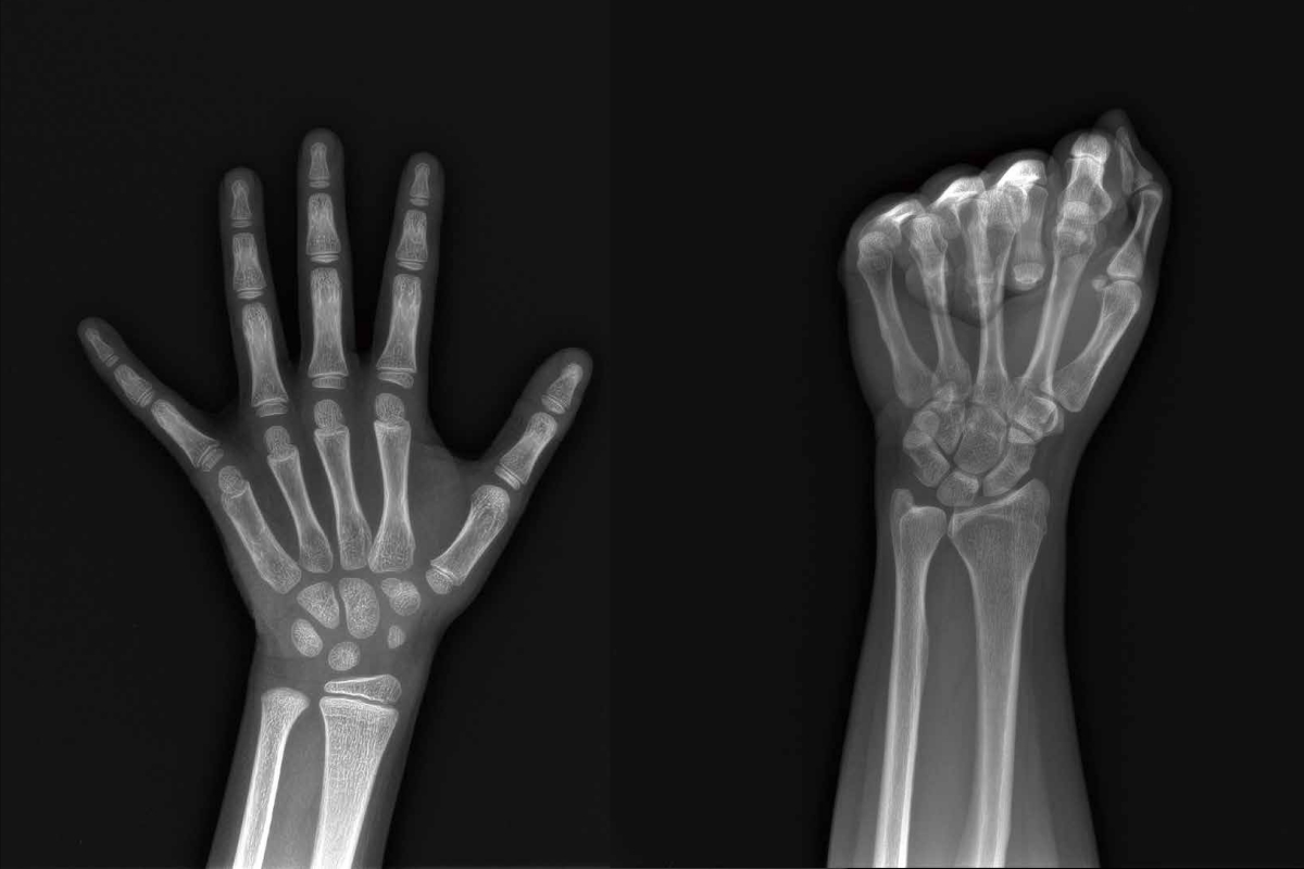 骨龄与骨密度有什么区别？解析两者的定义、检测与应用